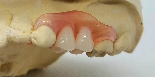 a Nesbit partial denture in a mold of a mouth
