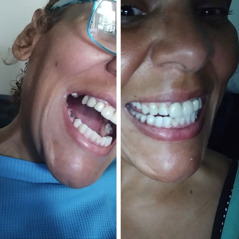 a woman wearing partials dentures for her back teeth
