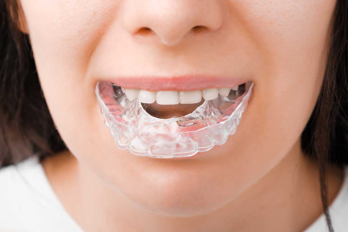 close-up of a woman's lower face as she smiles while wearing a clear orthodontic aligner over her teeth, highlighting dental health and cosmetic dental treatments