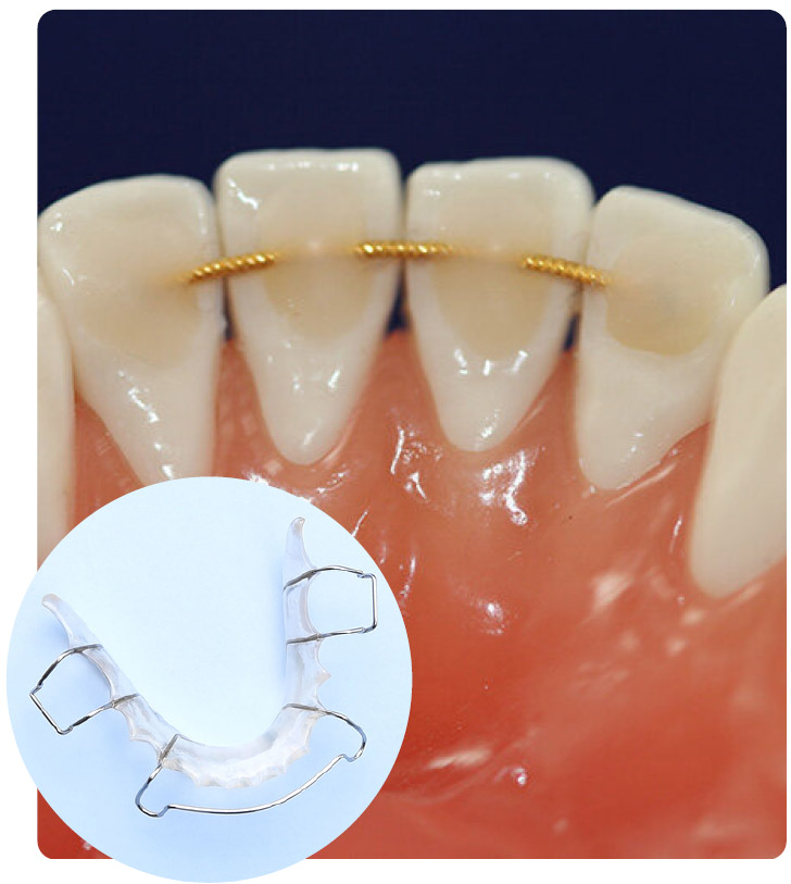 hawley retainer pros and cons 2 Hawley Retainers