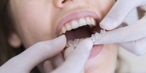 393753-PCF7JZ-870-min Nightguards for Bruxism: Teeth Grinding and Clenching
