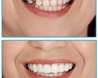 Benefits of Clip-on Dental Veneers like Clip-on-Smile